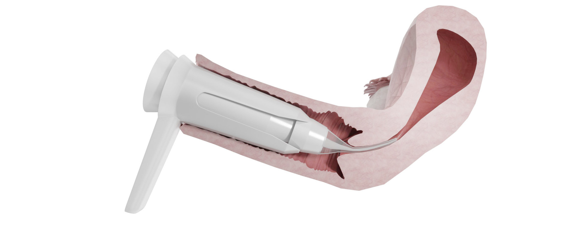 Uteroscope Dilator Carrier