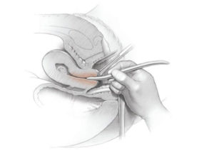 Cervix Dilation with Hegar 2