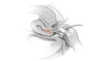 Cervix Dilation with Hegar 3